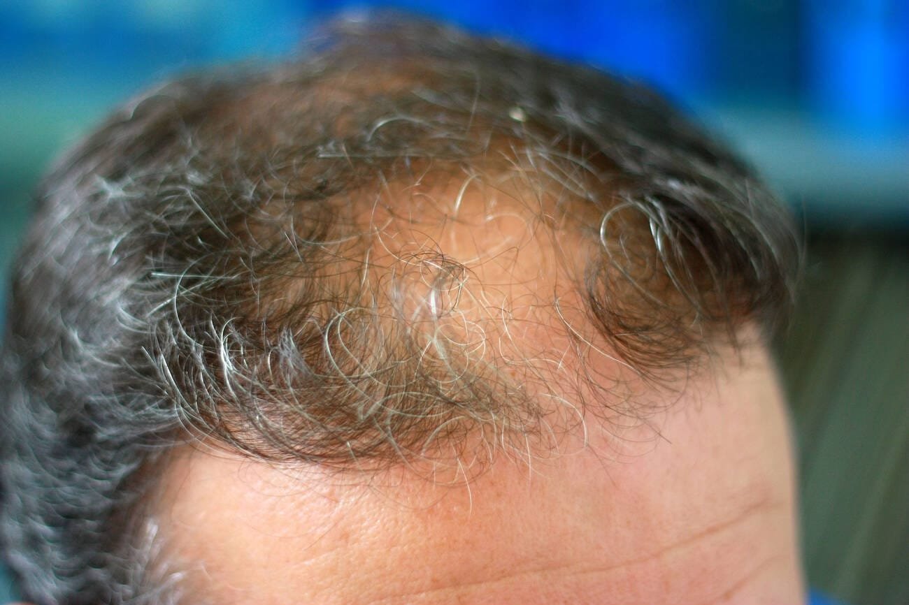 Can Stress Cause Hair Loss Understanding the Connection